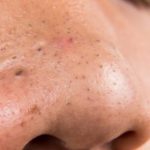 9 bước giúp bạn trị mụn đầu đen ở mũi