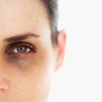 Quầng thâm mắt: Nguyên nhân và cách điều trị