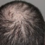 Hiểu về rụng tóc – các kiến thức cơ bản