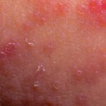 Eczema: Nguyên nhân, triệu chứng và cách điều trị
