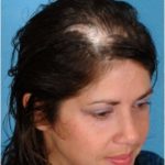 Hiện tượng rụng tóc có sẹo và phương pháp điều trị